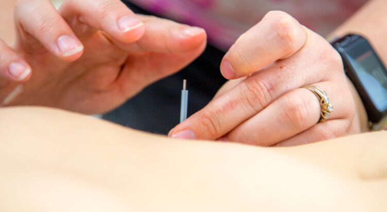 AC401 Acupuncture Techniques I